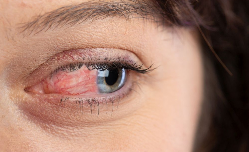 příčiny prasknuté žilky v oku