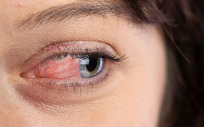 příčiny prasknuté žilky v oku