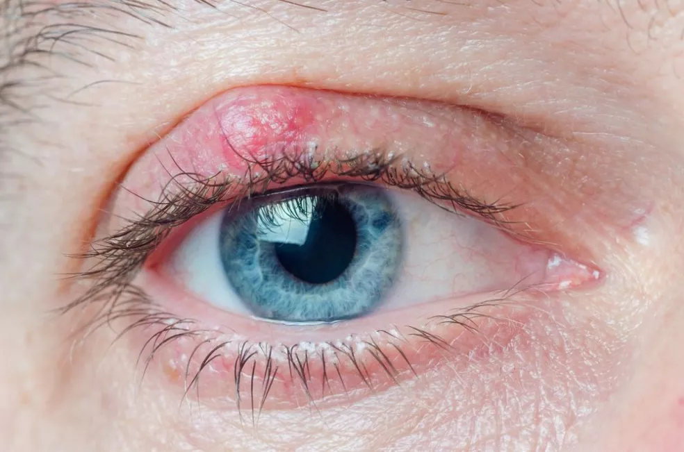 chalazion