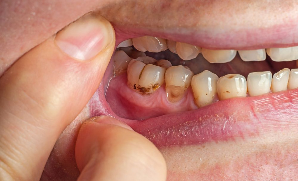 Ústupující dásně příčina i řešení