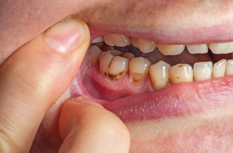 Ústupující dásně: Příčina tě překvapí, čti!