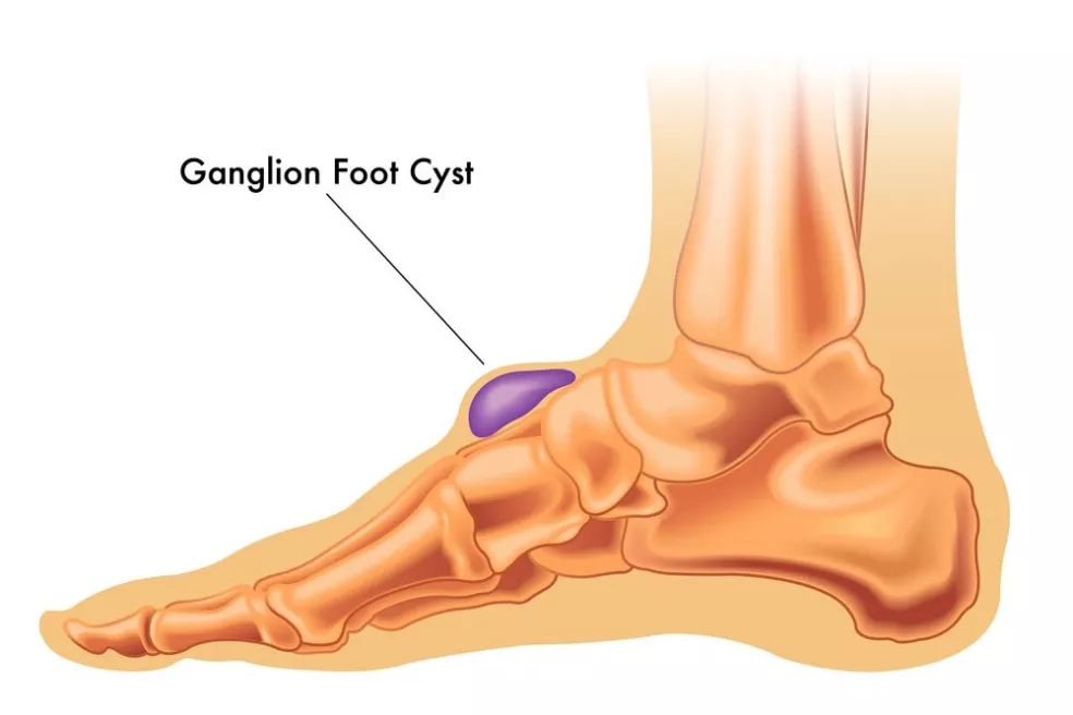 Gangliová cysta na chodidle