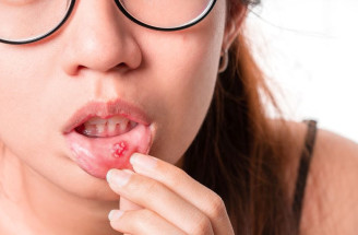 Bolestivé afti v ústech: Triky, které zabírají během 24 hodin!