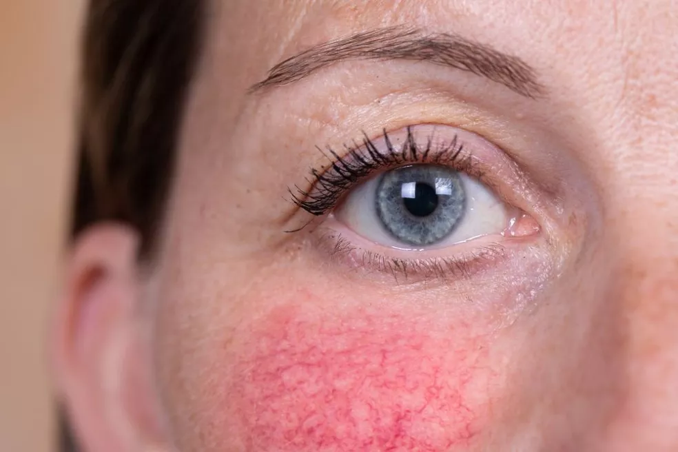 Rosacea (růžovka)