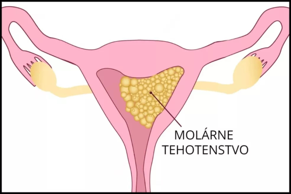 Molární těhotenství