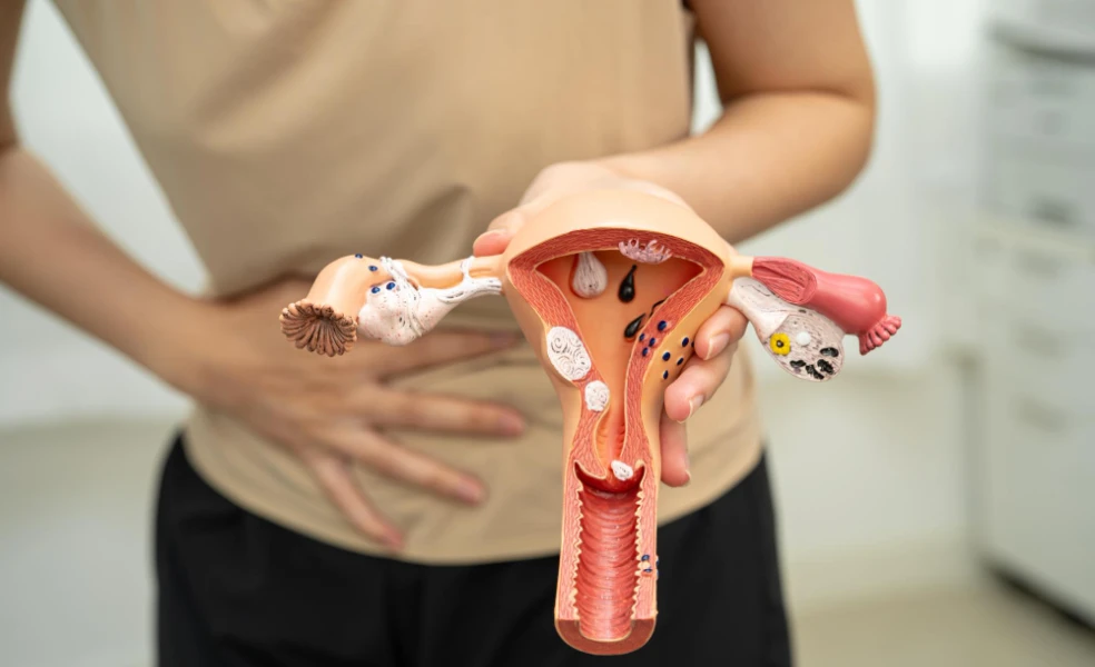 Ovariální hyperstimulační syndrom